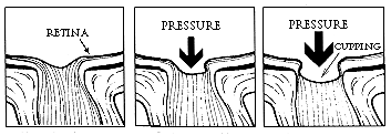 Eye Pressure Diagram